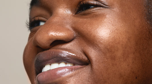 Melasma Mayhem: Unveiling the Mystery Behind Uneven Skin Tone